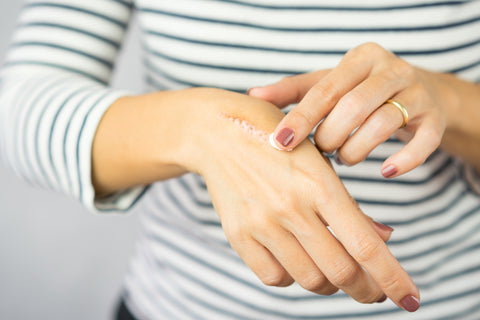 Frau cremt Wunde auf ihrer Hand ein